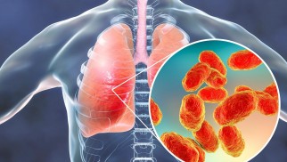 What is pneumonia and how is it treated? What is pneumonia and how is it treated?