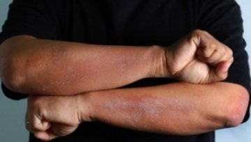 What are bacterial infections of the skin?