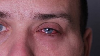 What is allergic conjunctivitis and how is it treated? What is allergic conjunctivitis and how is it treated?