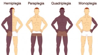 What is hemiplegia and how is it treated? What is hemiplegia and how is it treated?