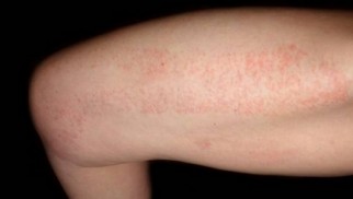 What is erythremia and how is it treated? What is erythremia and how is it treated?