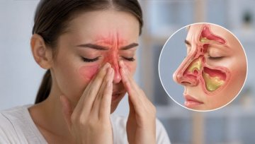 Sinusitis: When It Is Bacterial and When It Is Not