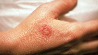 Skin diseases – symptoms, types, treatments Skin diseases – symptoms, types, treatments