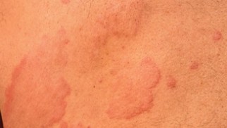What is acute and chronic urticaria and how is it treated?