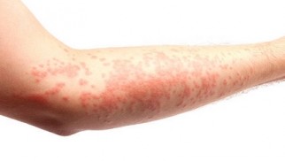 What is acute and chronic urticaria and how is it treated?