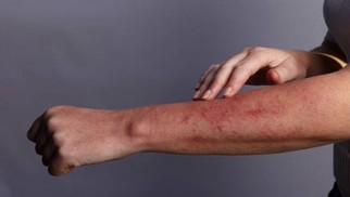 What is serum sickness and how is it diagnosed and treated? What is serum sickness and how is it diagnosed and treated?