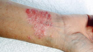 What is contact dermatitis and how is it treated?