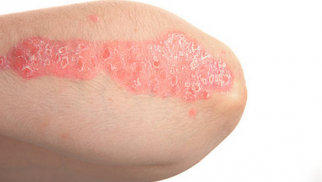 What is contact dermatitis and how is it treated?