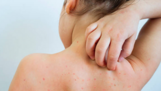 What is neurodermatitis, how to recognize and treat it? What is neurodermatitis, how to recognize and treat it?