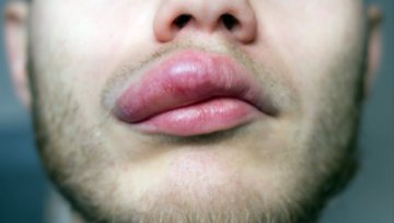 What is Quincke&rsquo;s edema and how is it treated?