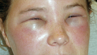 What is Quincke’s edema and how is it treated? What is Quincke’s edema and how is it treated?